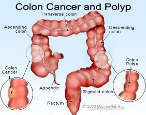 colon_cancer